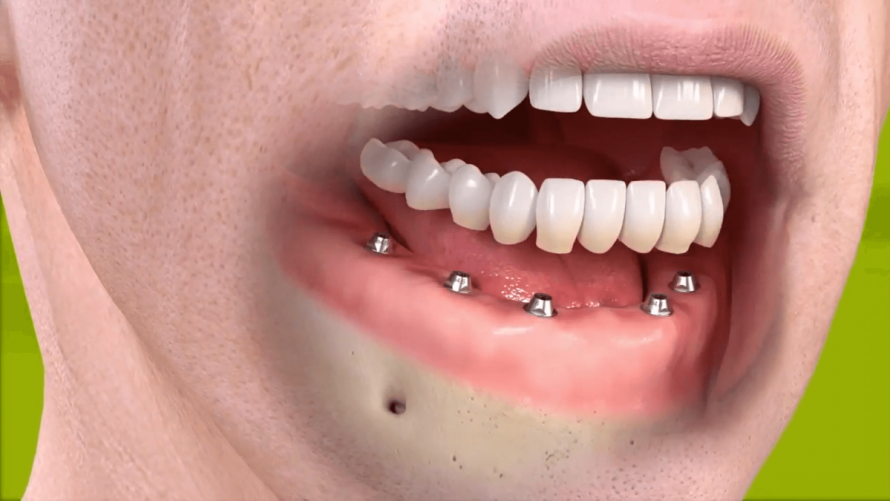 Gydytojas atsako: kas vyksta kūne, netekus dantų?