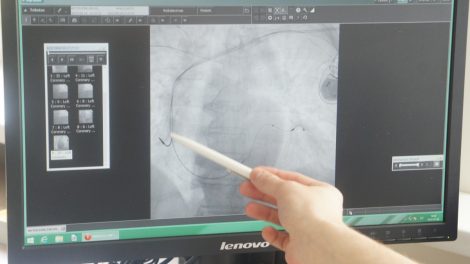 Ligoninėje implantuotas pirmas širdį rezinchronizuojantis stimuliatorius