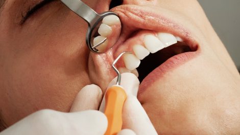 Atsitraukusios dantenos: ką vertėtų žinoti?