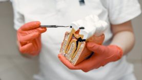 3 populiariausi mitai apie endodontinį gydymą