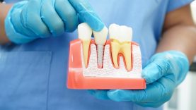 Dantų implantų privalumai: kodėl būtent šis dantų atkūrimo būdas?